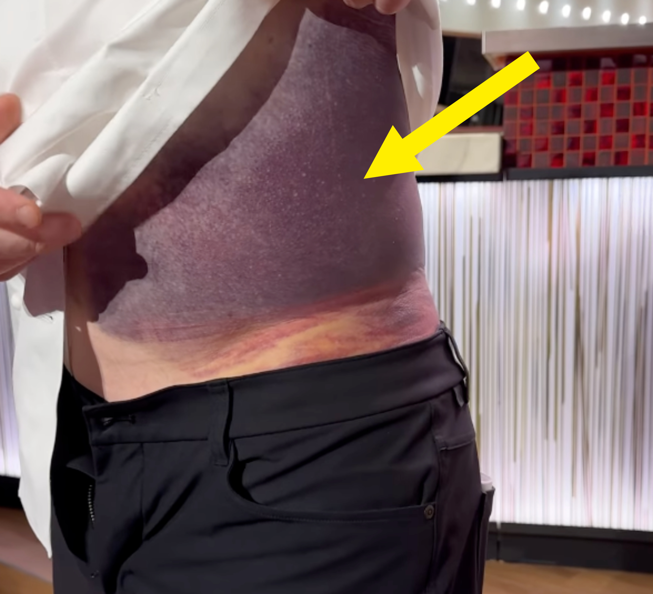 Person lifts their shirt to reveal a large recent tattoo covering their side and part of their torso, depicting a sunset ocean scene