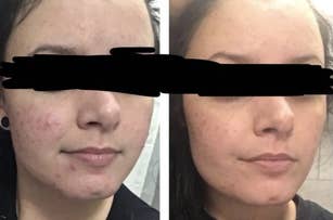 reviewer with visible acne on left and less visible acne on right 