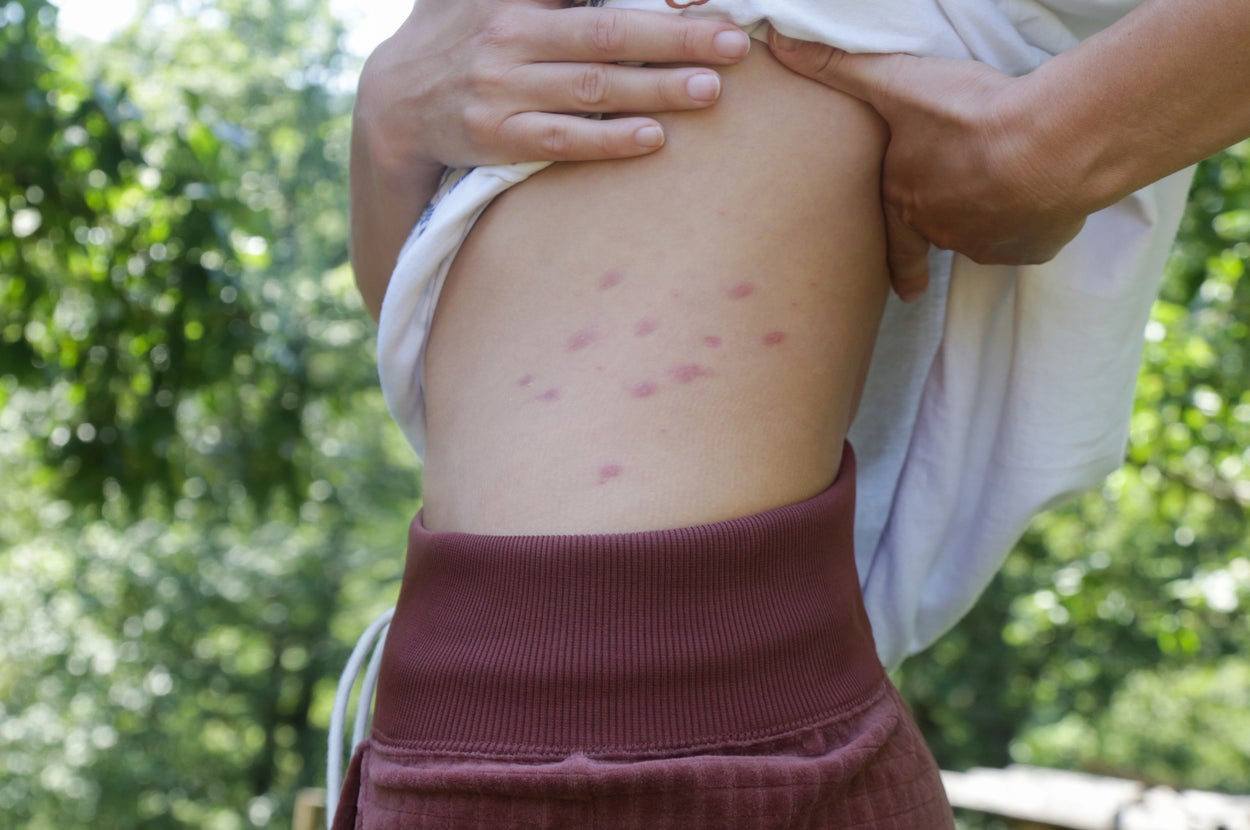 So THAT'S Why Mosquitoes Bite Some People More Than Others - BuzzFeed
