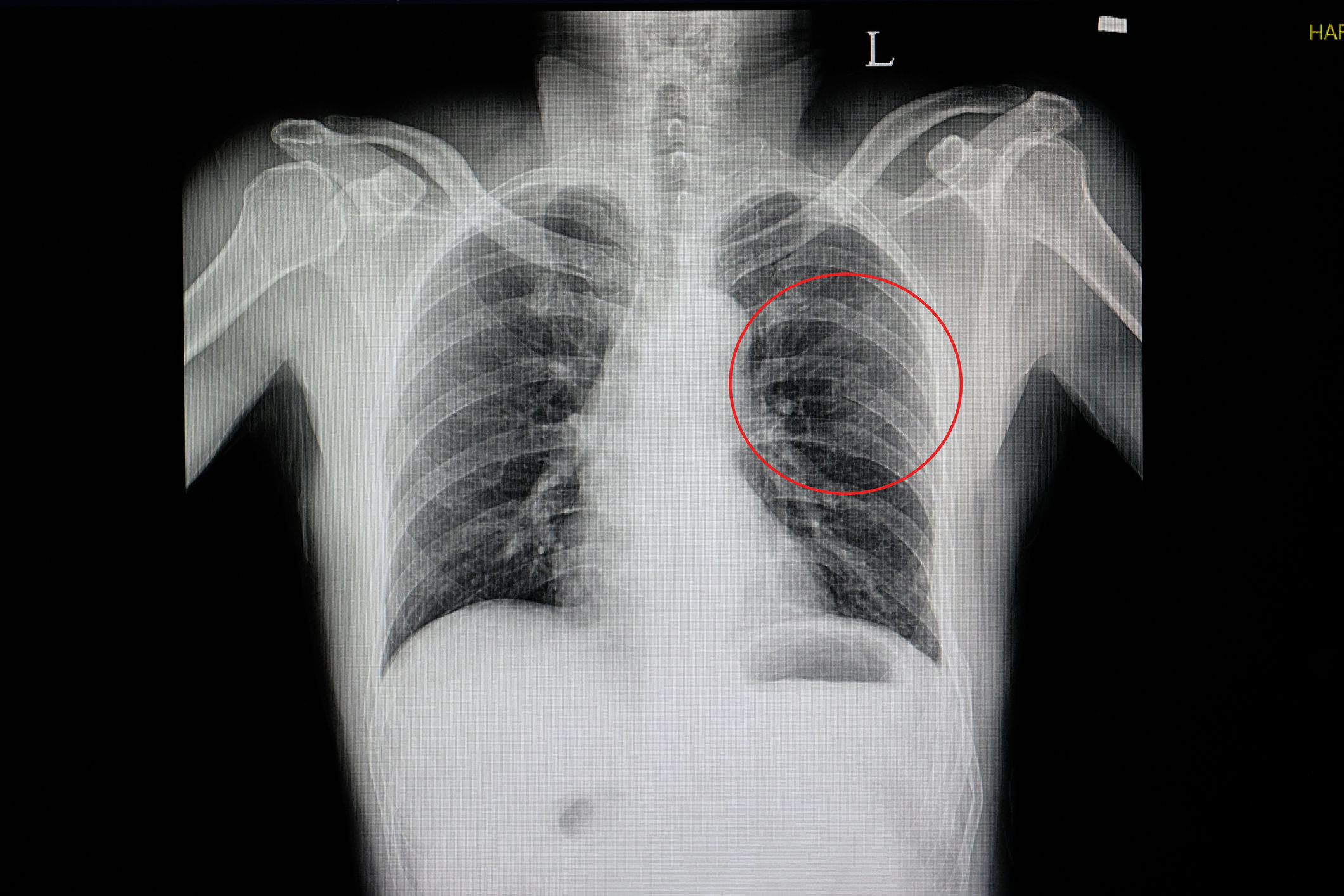 Chest X-ray highlighting a circular area on the left lung, possibly indicating a medical concern