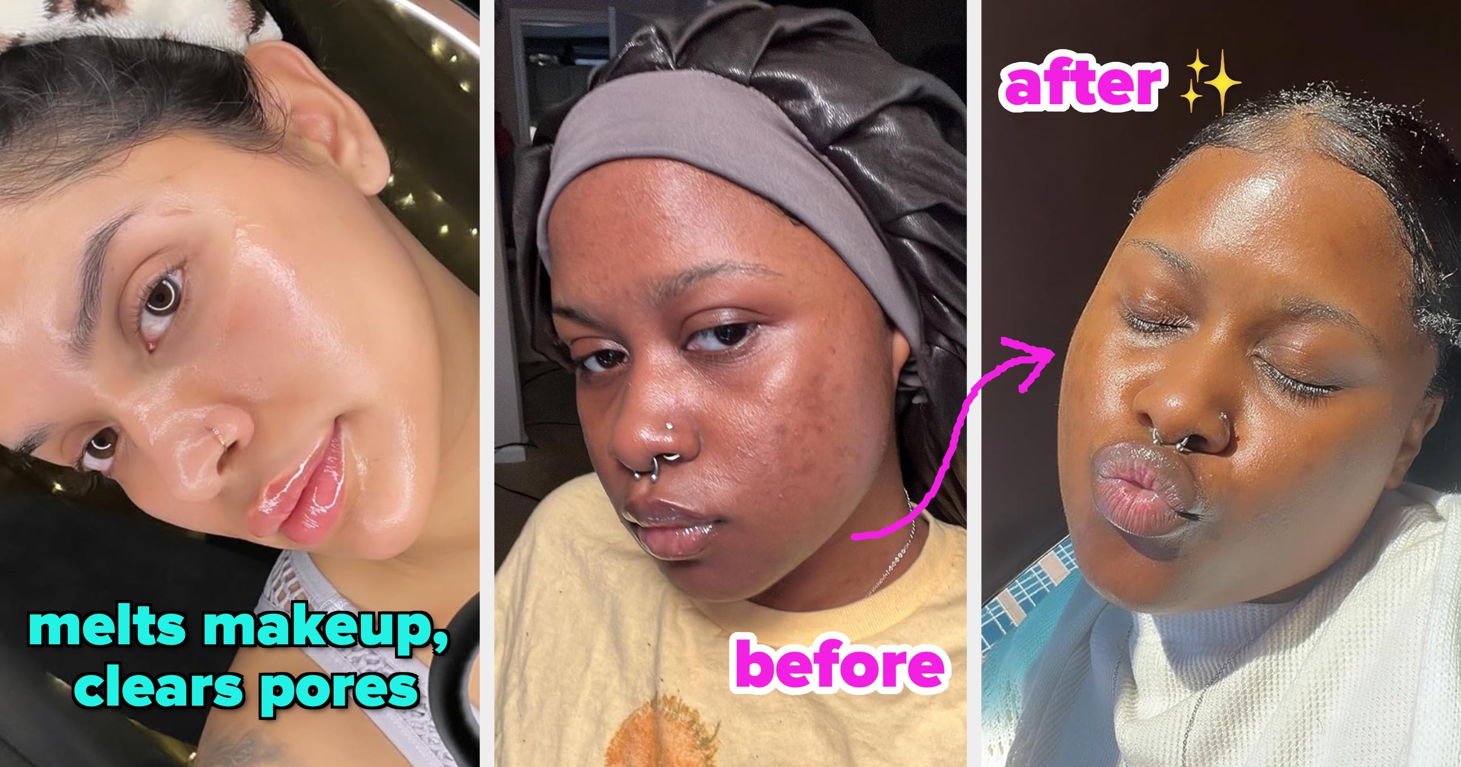 32 Korean Products For Blackheads, Breakouts, And More