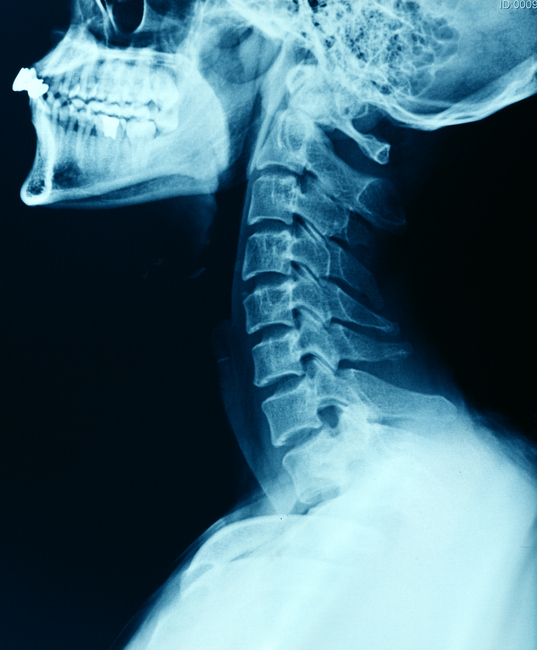 An X-ray image showing the side view of a human skull and cervical spine