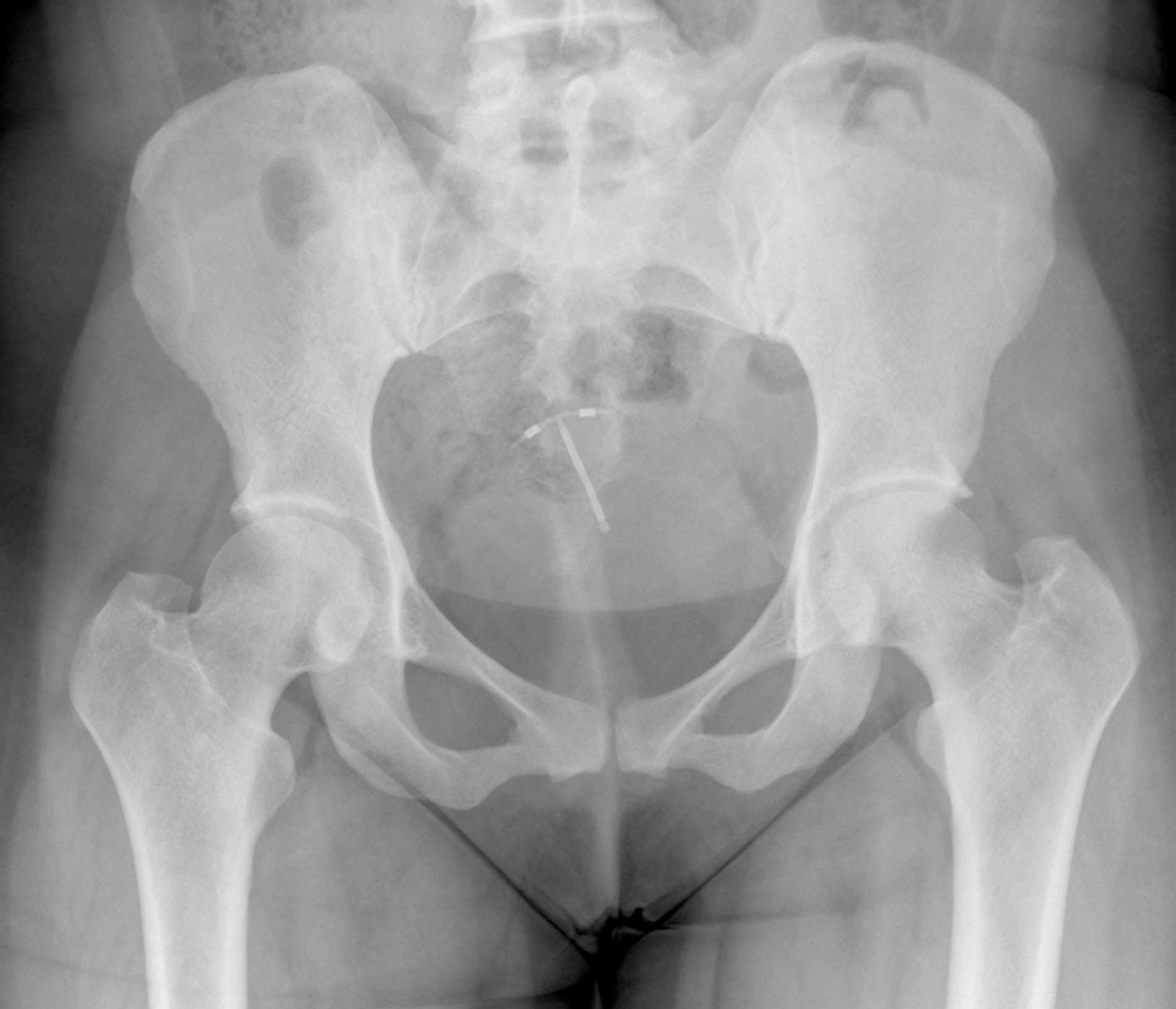 X-ray image showing the pelvis and hip bones with a small medical device visible in the central pelvic region