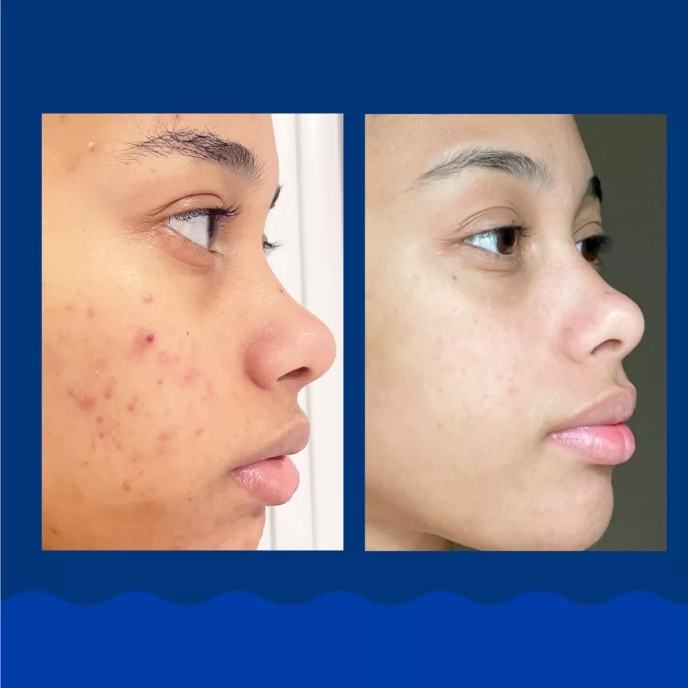 Side-by-side comparison photo showing skin improvement on a model's face, with acne visible on the left and clearer skin on the right