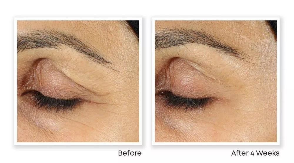 Before and after images showing the results on an eyelid of a beauty treatment over four weeks, visibly reducing wrinkles and fine lines