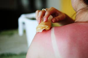 Close-up of a person applying a remedy to their sunburned shoulder with a clear strap mark visible