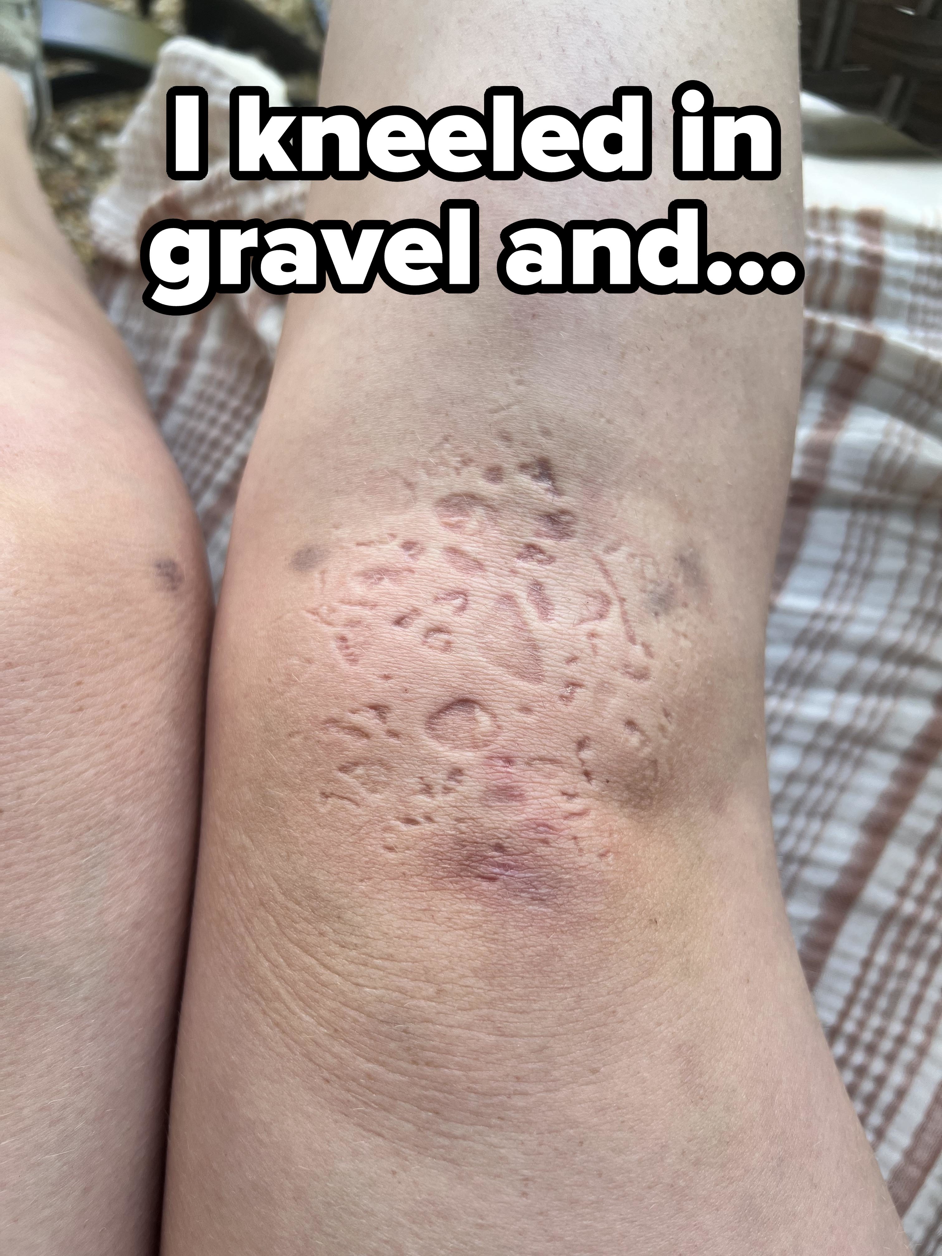 The image shows a close-up of a person's skin with a visibly rough, dry patch on the knee that appears to be irritated or inflamed