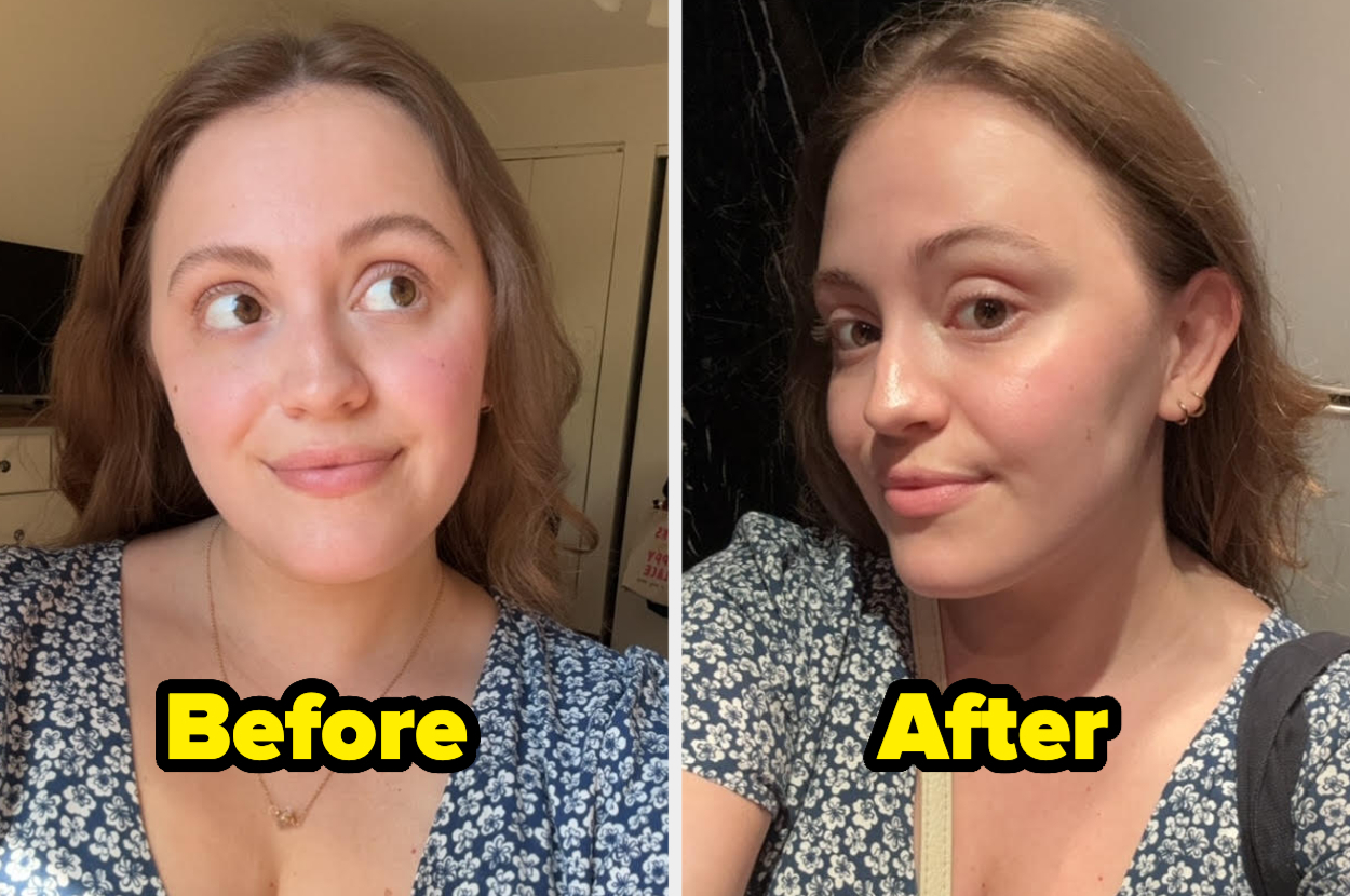 Woman showing before and after skincare results, wearing a floral dress. The "before" photo is on the left, and the "after" photo is on the right