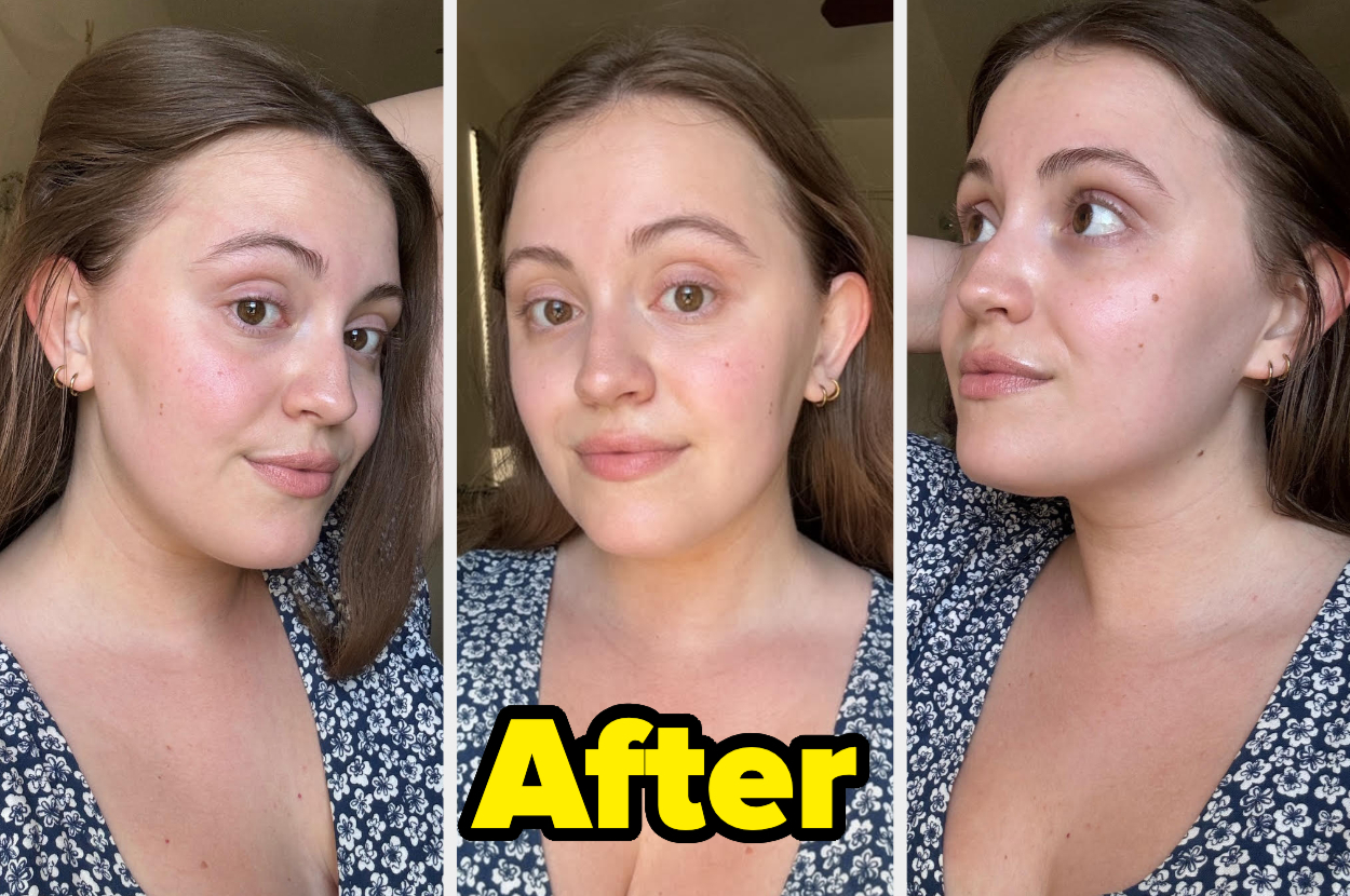 Three side-by-side close-up photos of a woman with smooth, glowing skin, wearing a floral dress. The text "After" is overlaid at the bottom