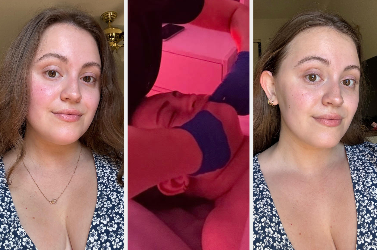 Close-up shots of a woman before and after a skincare treatment, with a middle image showing the treatment in progress