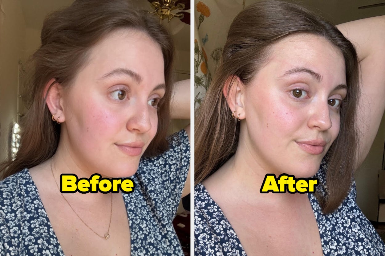 two images of a woman's profile labeled "before" and "after"
