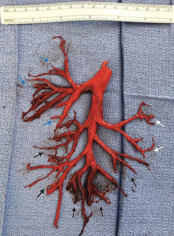 A blood clot that looks like a detailed model of bronchial tree anatomy lies on a blue surgical drape next to a measuring ruler. The branching structure showcases the complexity of airway passages.