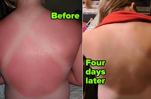reviewer's sunburned back and then redness calmed four days after using sun soother