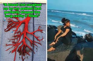 Close-up of a blood clot shaped like lung branches next to a photo of a woman in black exercising on beach rocks at the ocean. Text: "A blood clot coughed up by my patient that perfectly shaped the lung cavity it filled."