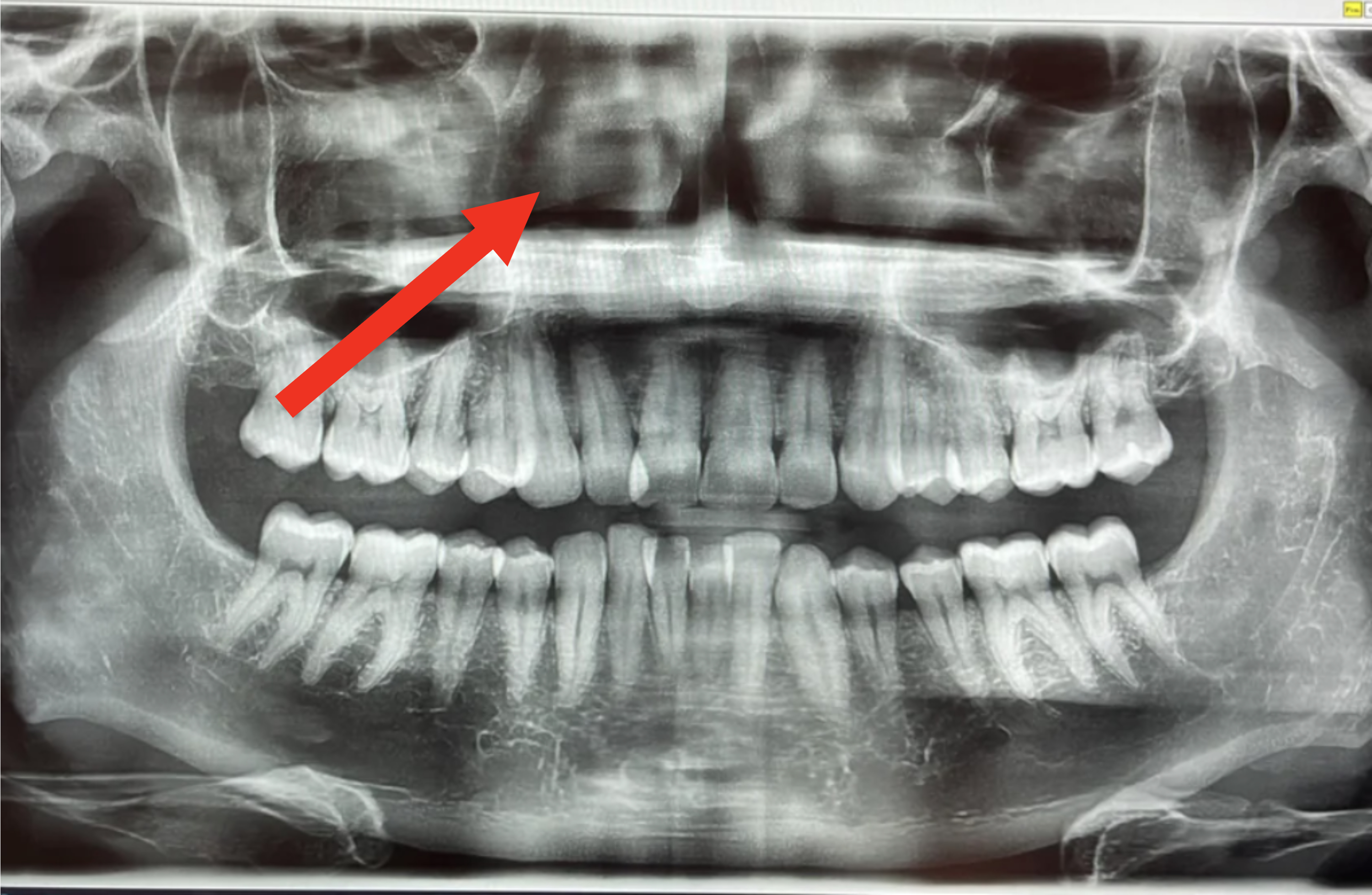 An X-ray image showing a full set of adult human teeth, highlighting the jaw, teeth alignment, and bone structure