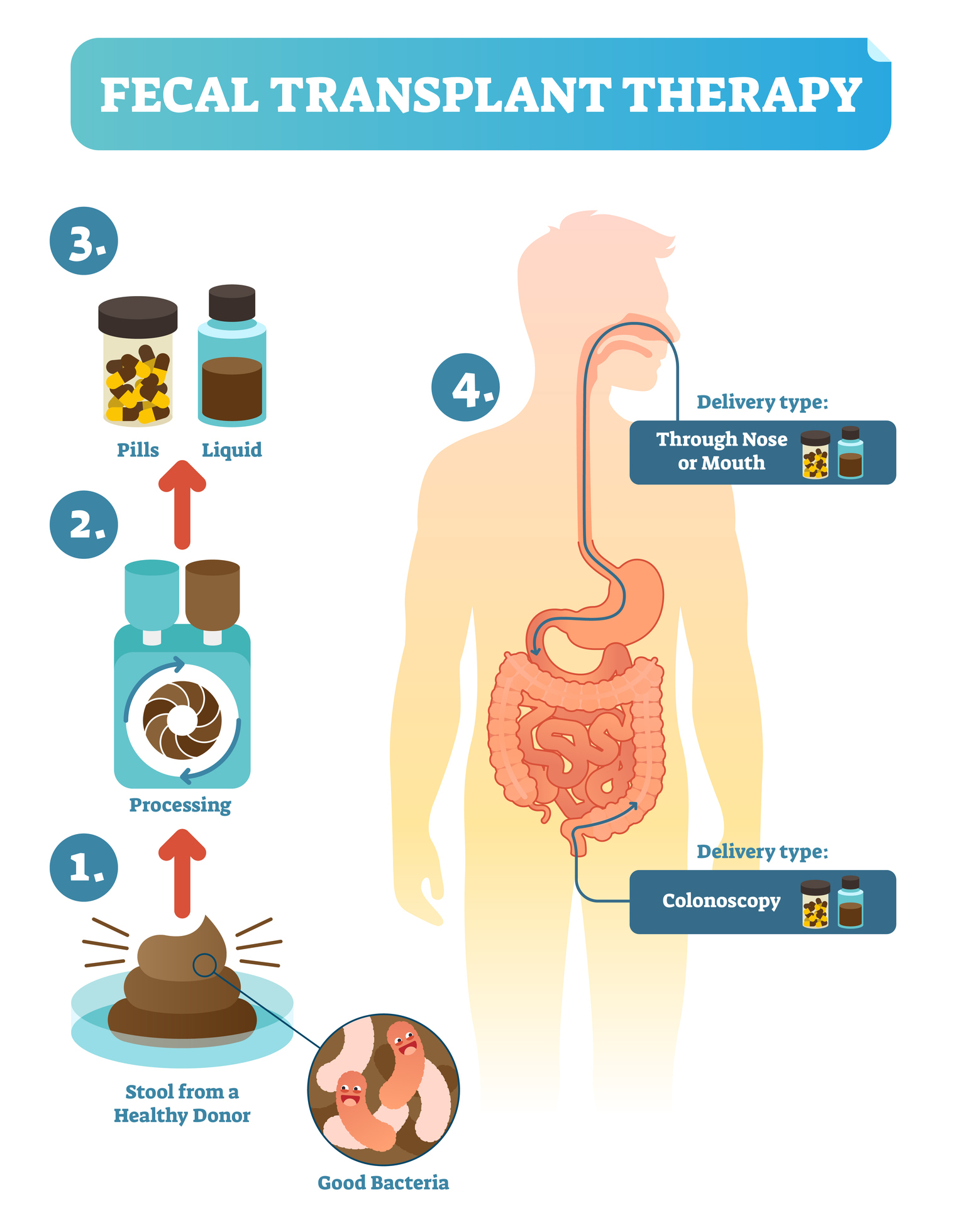 Infografikk om fekal transplantasjonsterapi.  Trinn inkluderer avføring fra en frisk donor, behandling, inntak via piller eller væske, og levering gjennom nese/munn eller koloskopi