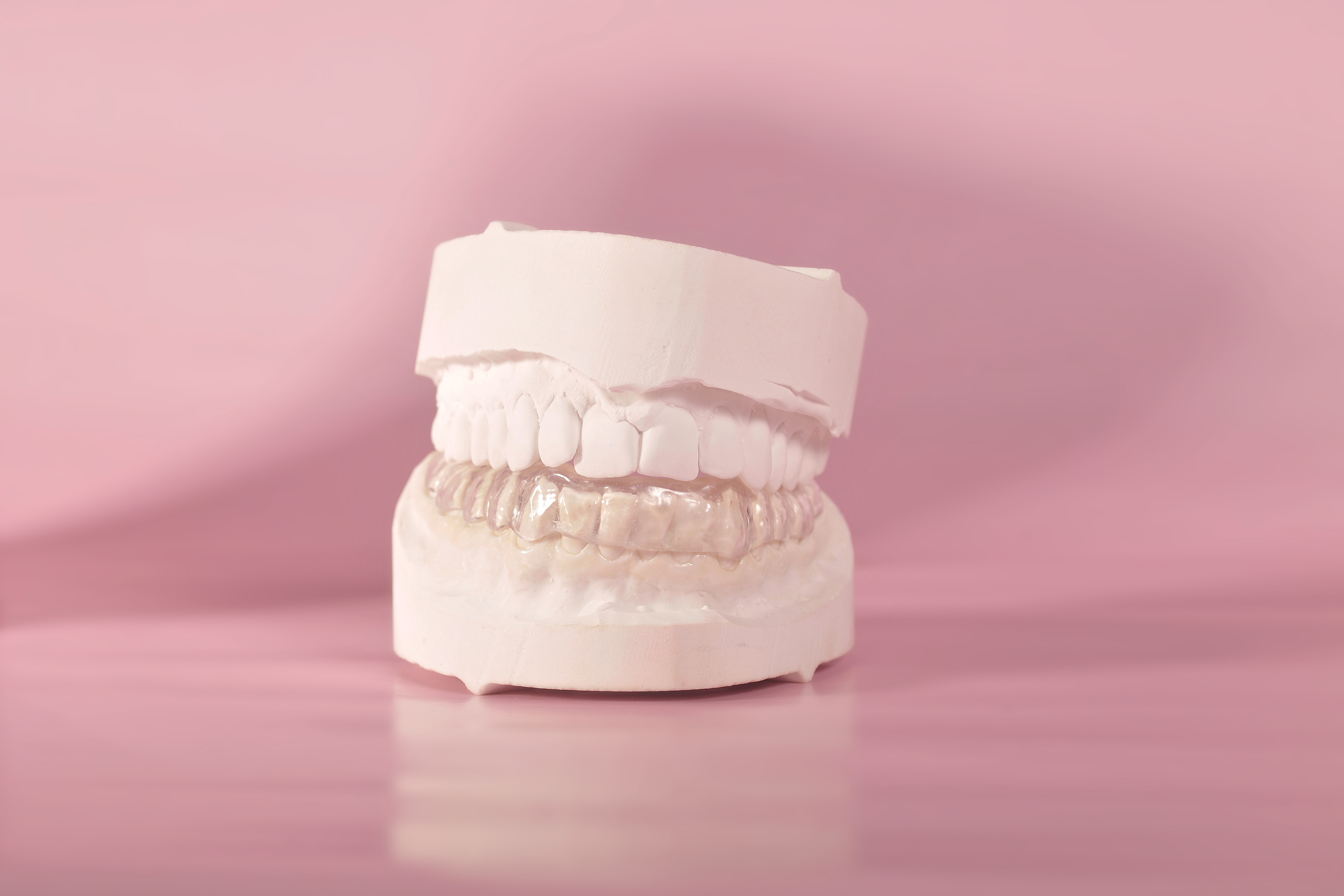 A dental mold showcasing a set of teeth with a clear aligner placed on them against a plain background
