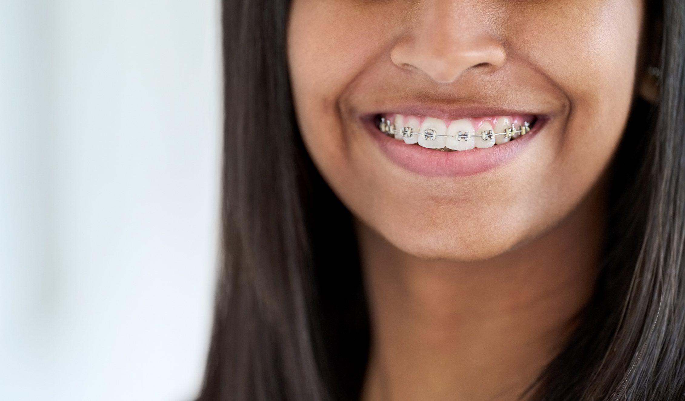 A close-up of a person smiling, showing braces on their teeth