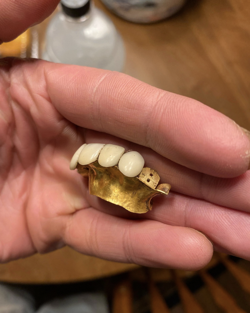 A hand holds a gold dental prosthesis with several attached artificial teeth