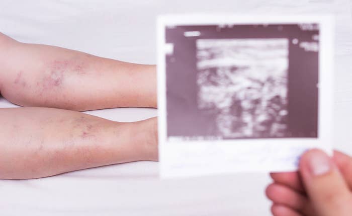 A partial view of two legs with visible bruising and a blurred ultrasound image in the foreground being held by a hand
