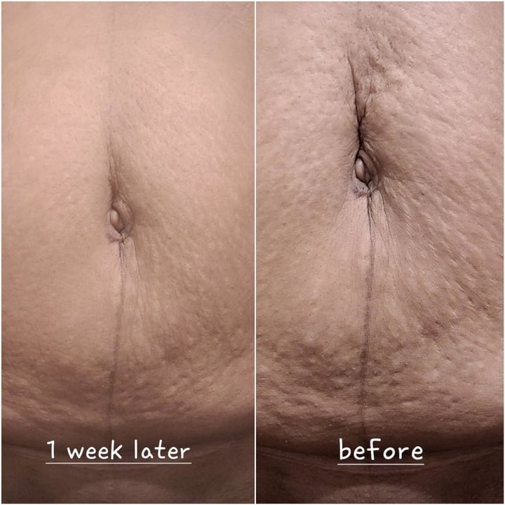 reviewer tummy before and after using Bum Bum cream