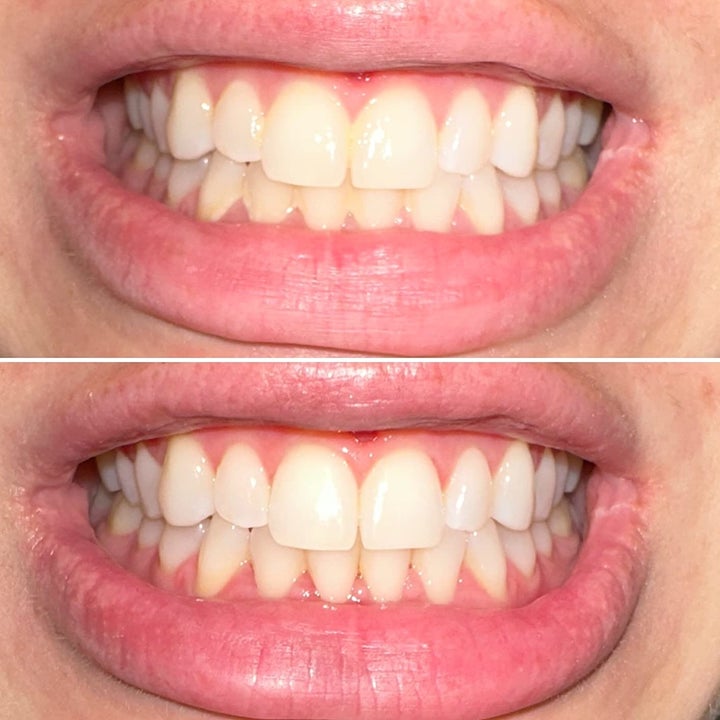 reviewer's teeth before and after using the toothbrushes, looking visibly cleaner