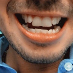 Close-up of same reviewer smiling, showing a significant improvement in their teeth