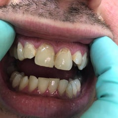 Close-up of a reviewer's mouth showing discolored and damaged teeth being examined by someone wearing blue medical gloves