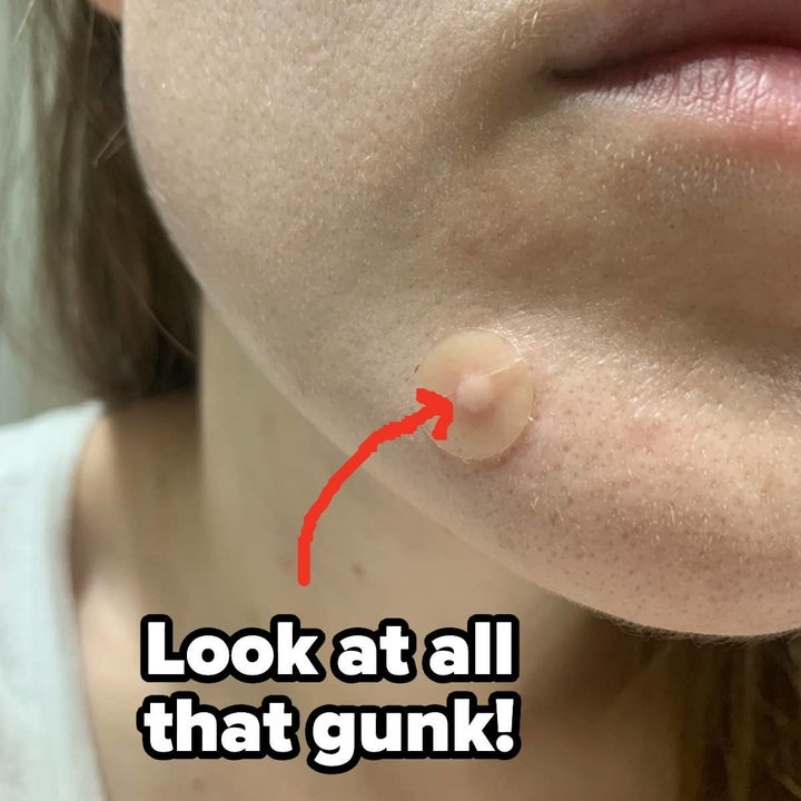 same reviewer's face with pimple patch applied showing all the gunk that came out