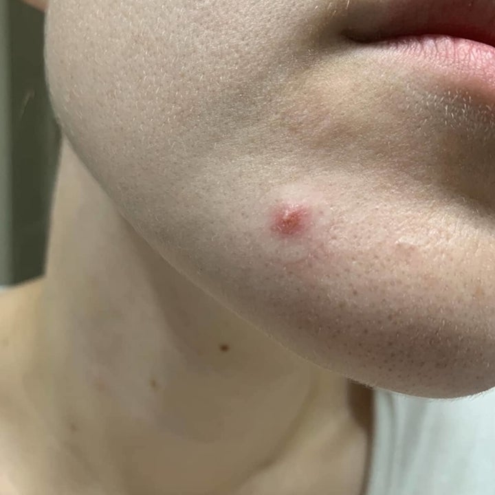 Close-up of a reviewer's lower face with a visible pimple on their chin