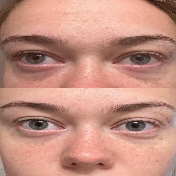 comparison of a reviewer's under eyes before and after applying under-eye masks