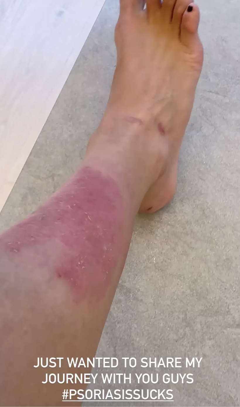 Closeup of Kim Kardashian's psoriasis outbreak on her legs
