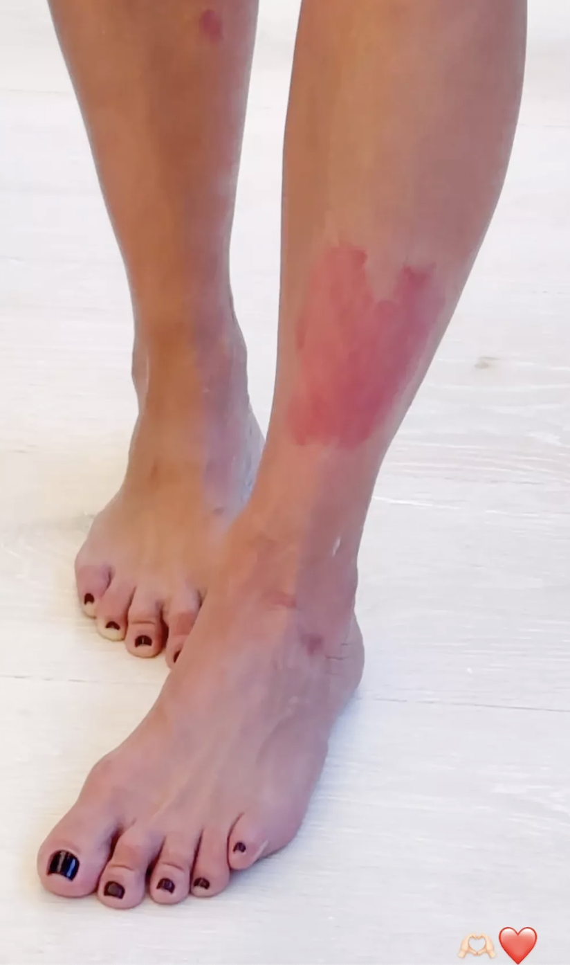 The image shows a close-up of an Kim's legs with a visible red rash on the left shin