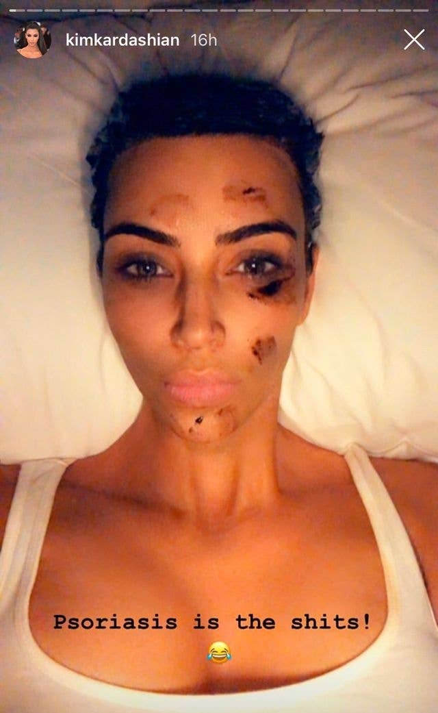 Kim Kardashian lying in bed with psoriasis treatment on her face and a caption that reads, "Psoriasis is the shits!" with a laughing emoji
