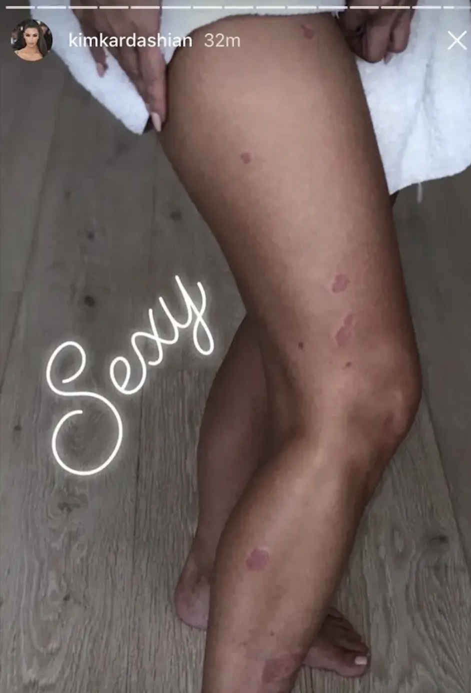 Kim Kardashian legs with psoriasis spots, visible text "Sexy"