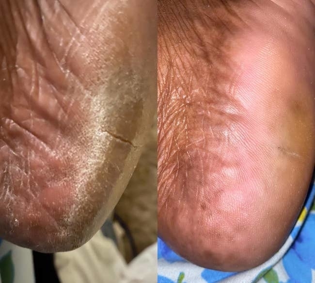 Close-up of the back of a person's foot shown before and after application of a moisturizing product; the second image shows improved skin texture with less dryness