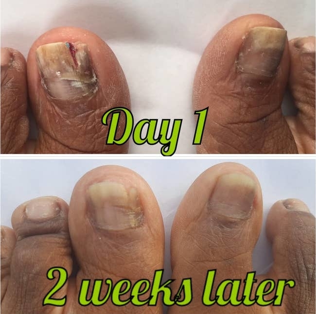 Close-up of toenails, showing significant improvement from Day 1 to 2 weeks later. The first image has damaged toenails while the second shows healed, healthy nails