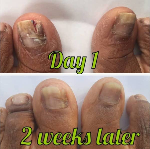 Close-up of toenails, showing significant improvement from Day 1 to 2 weeks later. The first image has damaged toenails while the second shows healed, healthy nails