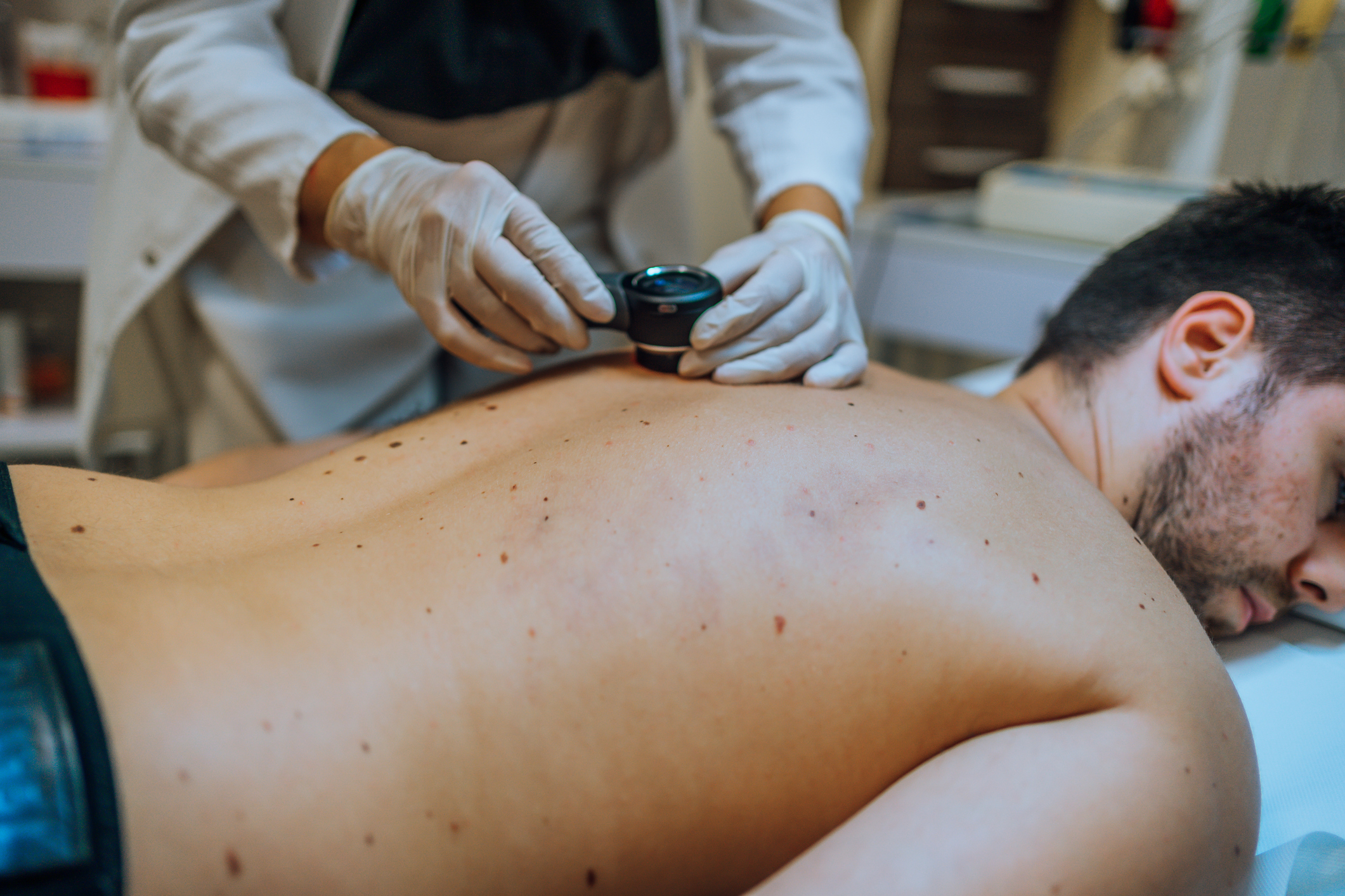 En person ligger med ansiktet ned på et medisinsk undersøkelsesbord mens en helsepersonell inspiserer ryggen med et dermatoskop