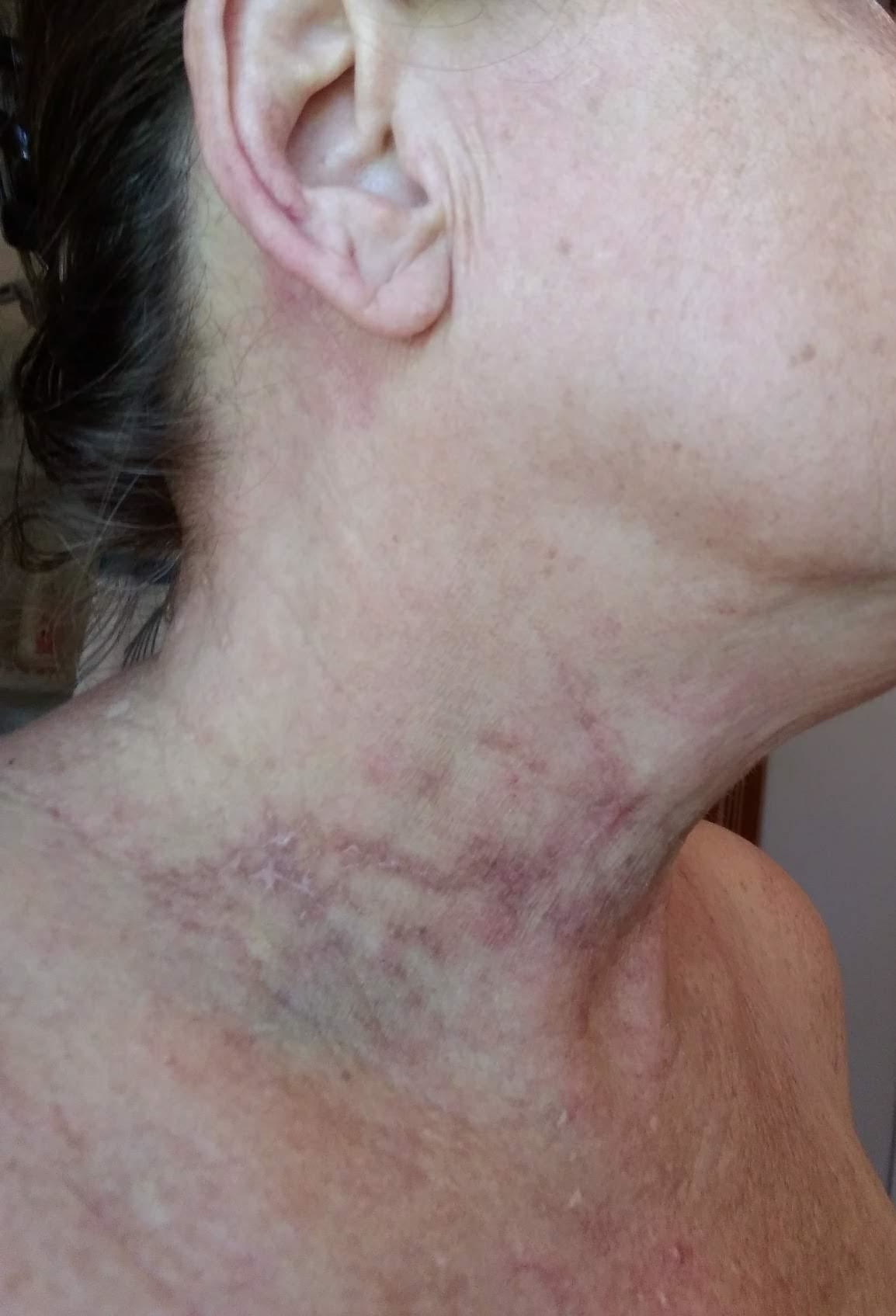 The same reviewer's neck after use, with the darkness almost completely gone and no puss or sores
