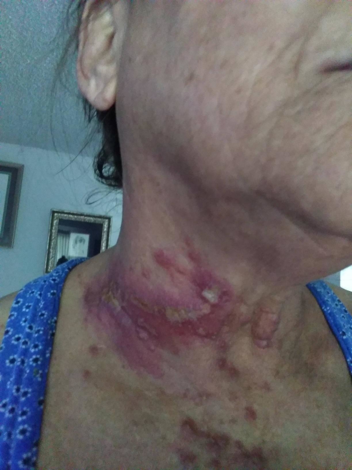 Reviewer with very dark, almost purple red rash on neck with what looks to be puss-filled buildup in certain areas