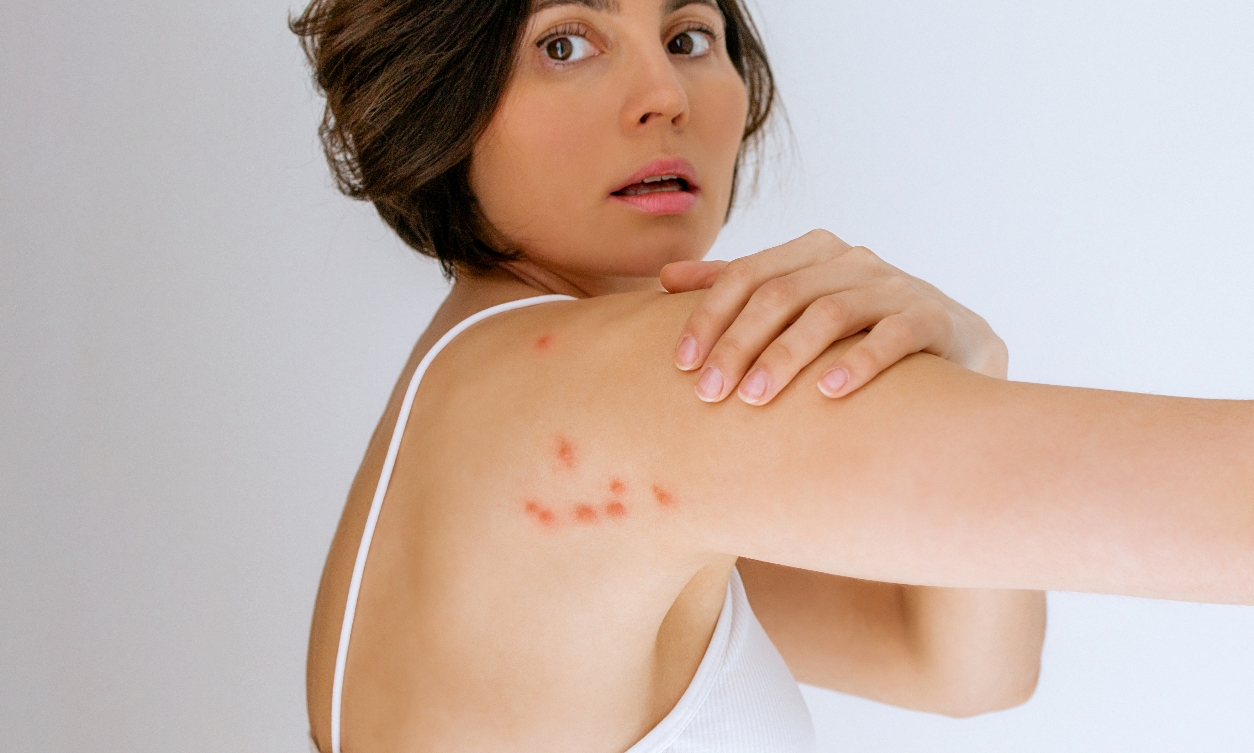 A woman looks over her shoulder, showing several red bumps on her upper arm