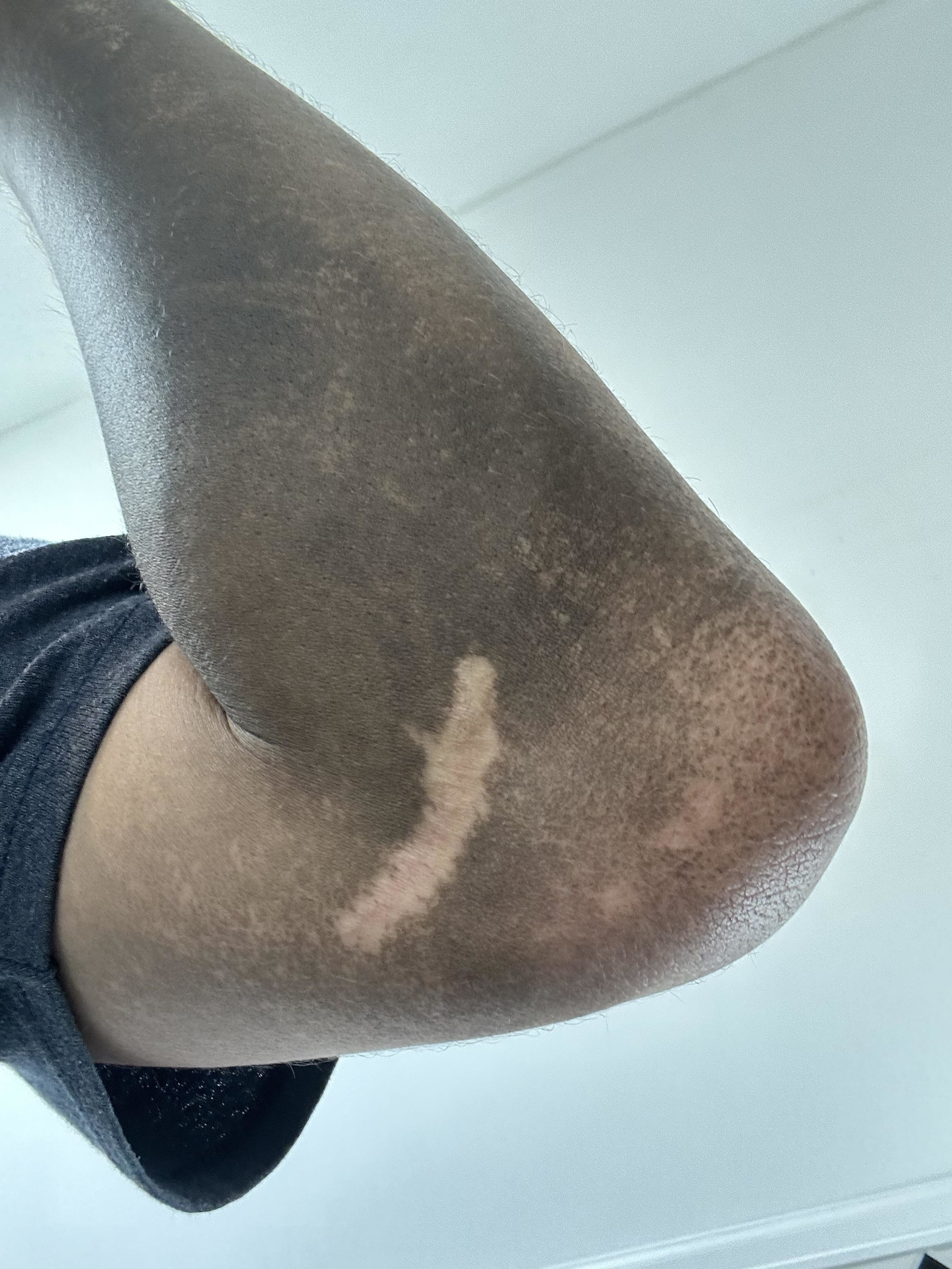 Close-up of a person's elbow with a scar. The person is wearing a short sleeve shirt