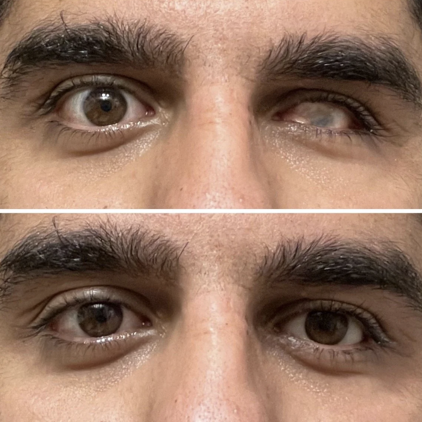 Two close-up images of a man's eyes. The top image shows the left eye closed and the right eye open. The bottom image shows both eyes open, looking straight ahead