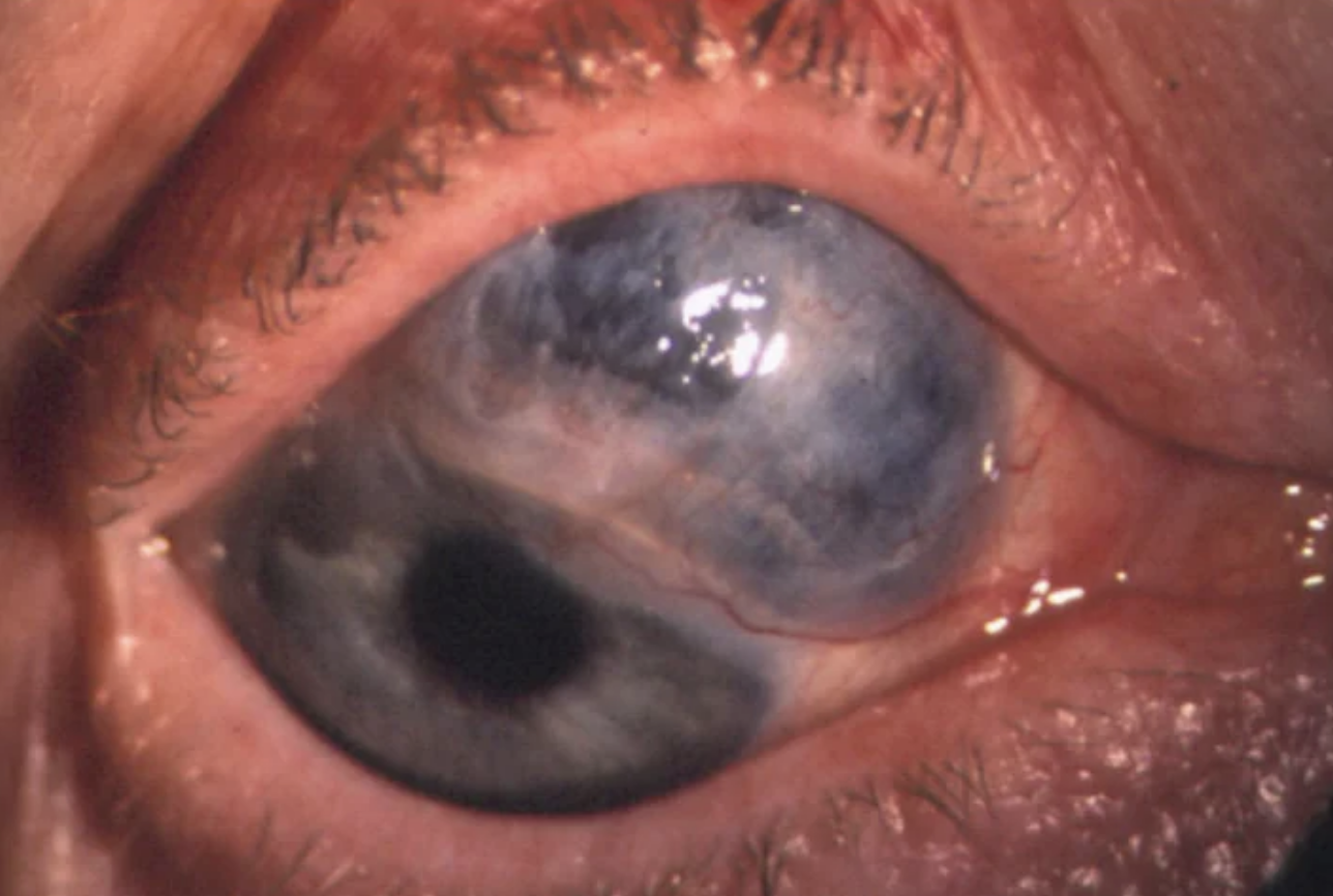 Close-up of a human eye with an irregular corneal surface, possibly indicating a medical condition