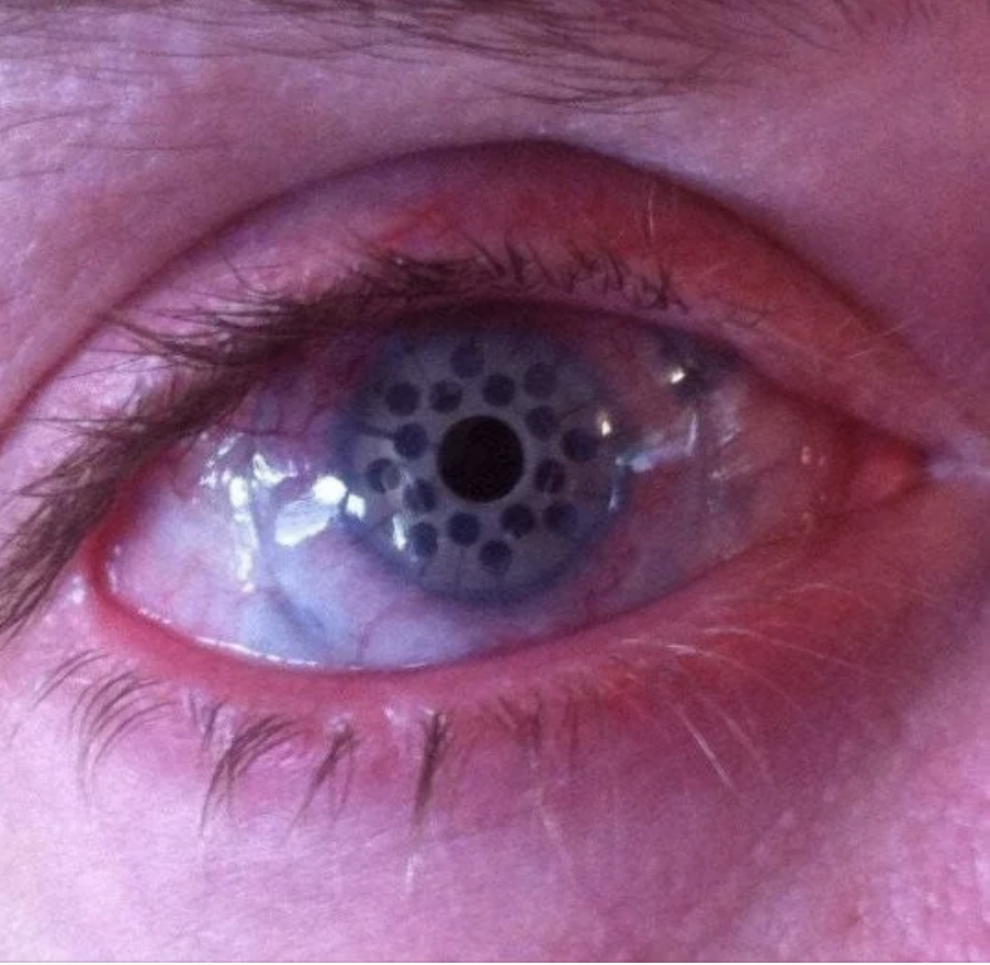 Close-up of an eye with a unique contact lens featuring a black dot design over the iris