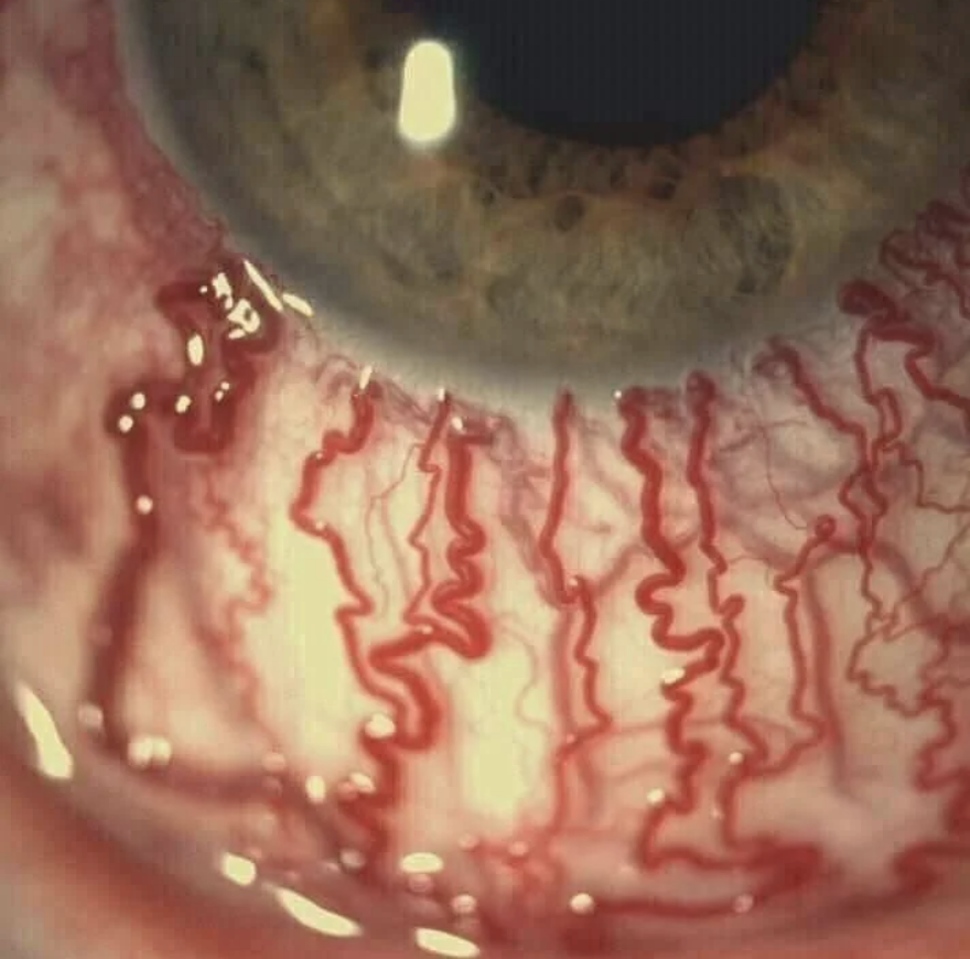 Close-up of an eye with prominent red veins on the sclera, surrounding the iris, indicating irritation or possible infection. No people or text in the image