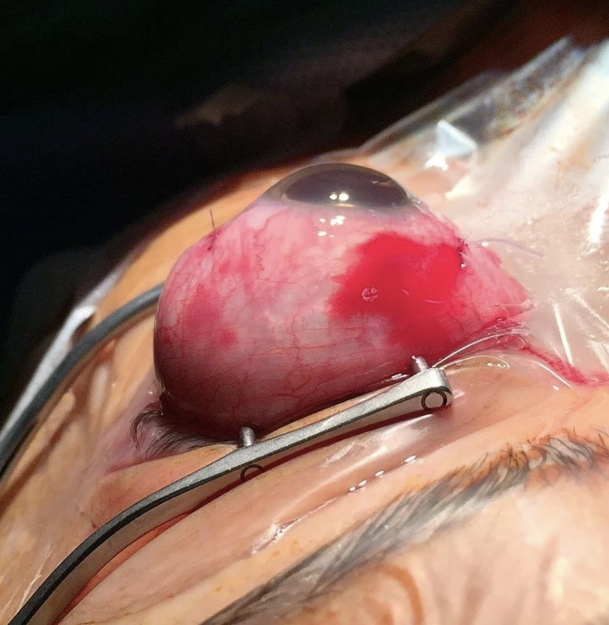A close-up image of a person's eye during cataract surgery, showing the eye exposed and the surgical apparatus in place