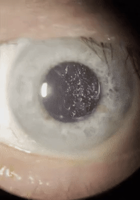 An animated close-up image of a human eye undergoing a medical process, possibly laser treatment or examination, with visible particles on the eye's surface