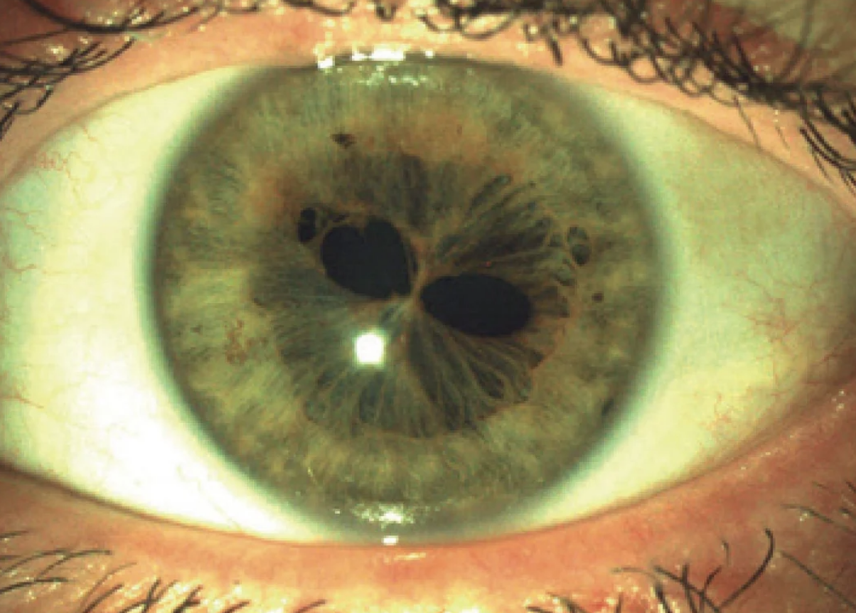 Close-up of a human eye with a condition called Polycoria, displaying multiple pupils within the iris